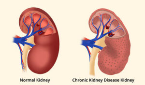 ckd