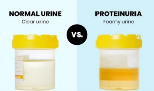 protein in urine